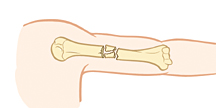 Parte superior del brazo donde se observa una fractura conminuta.